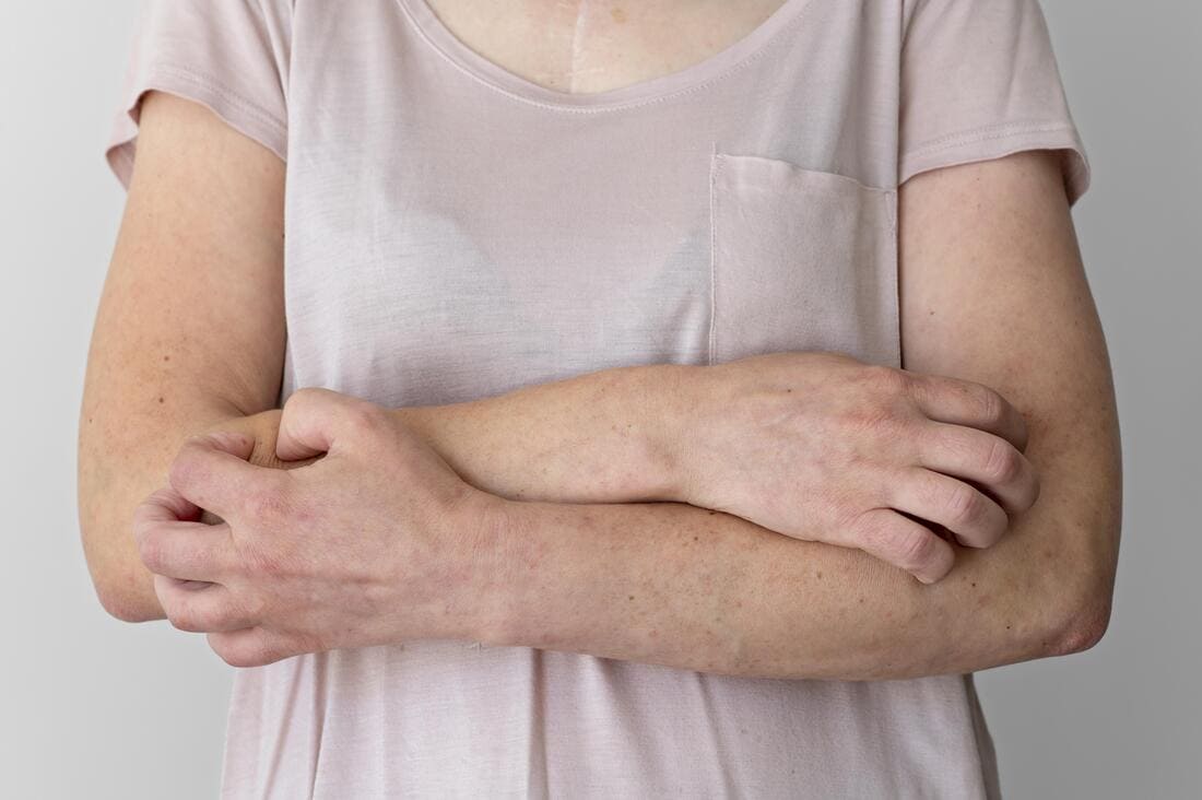 Une femme se gratte les bras et ne sait pas si c'est du psoriasis ou de l'eczéma.