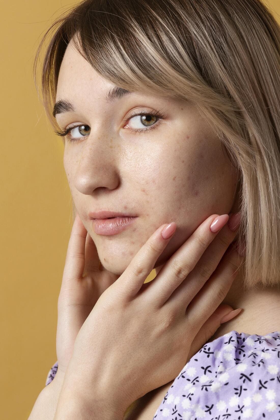 Une femme touchant son visage car elle a une peau à tendance acnéique.